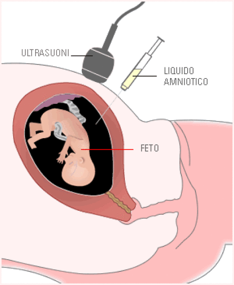 Amniocentesi Archivi La Gravidanza